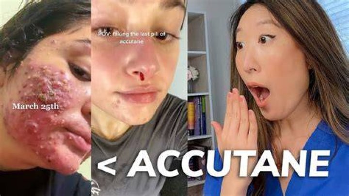 Is there a generic Accutane?