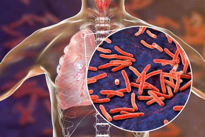 Is tuberculosis a virus or bacteria or fungus?