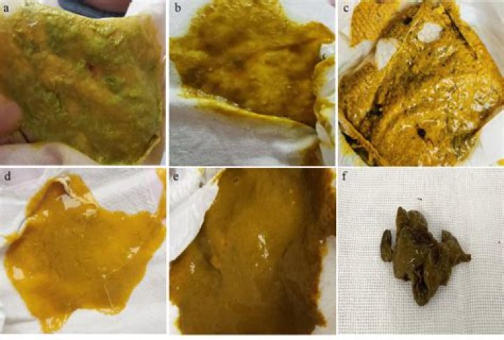 Is yellow diarrhea a sign of infection?
