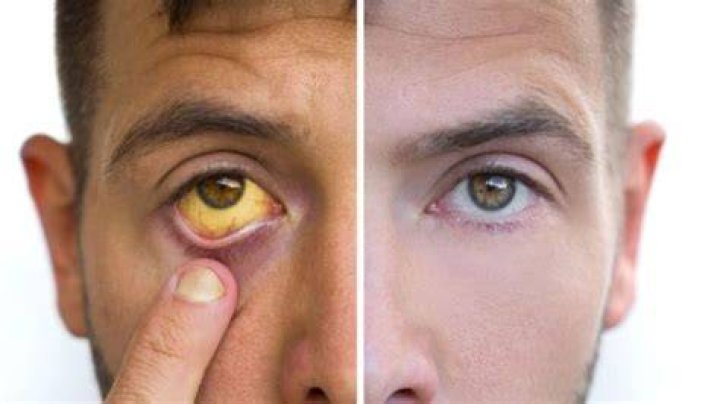 Is yellow jaundice catching?