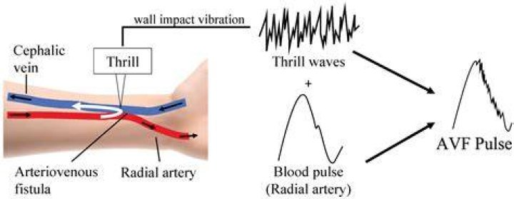Should an AV fistula have a thrill?