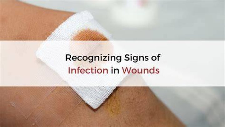 Should you squeeze pus out of an infected wound?