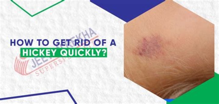 What's the quickest way to get rid of a hickey?