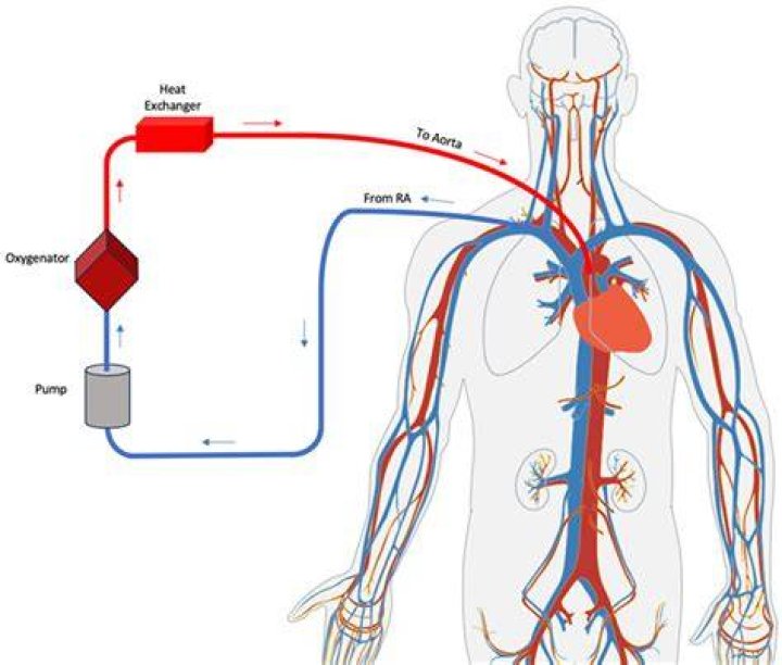 What are extracorporeal devices? | ContextResponse.com