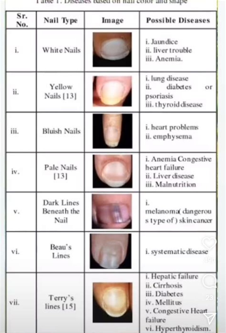 What are the other diseases of the nail?