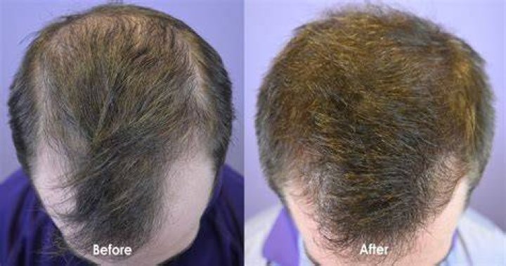What are the side effects of using Rogaine?