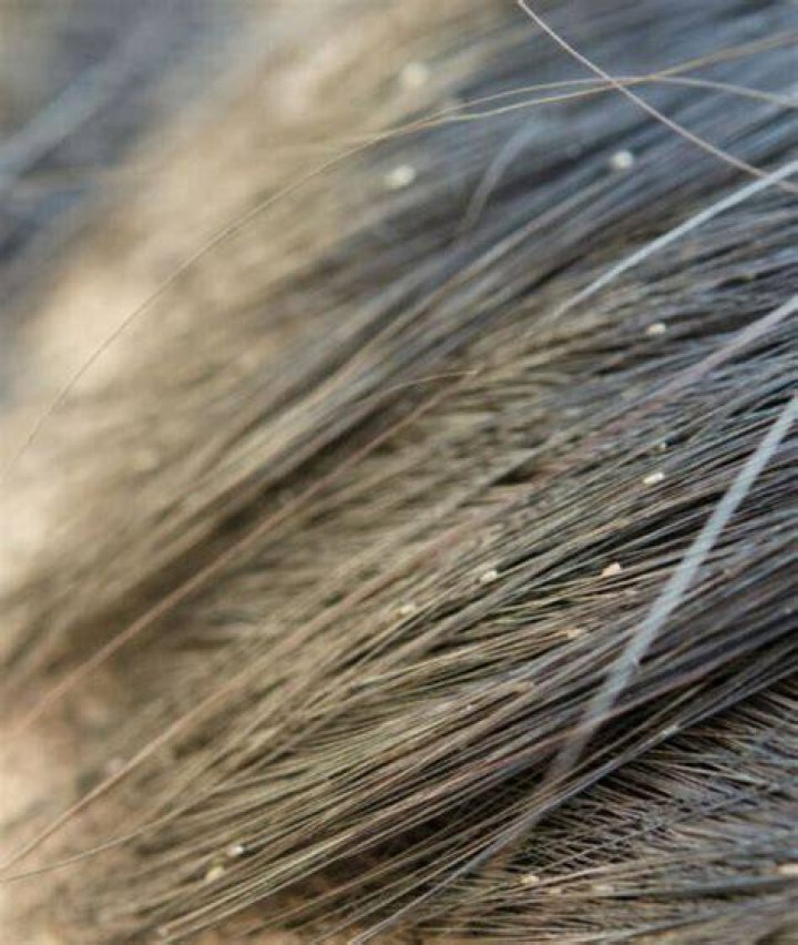 What bugs can be in your hair?