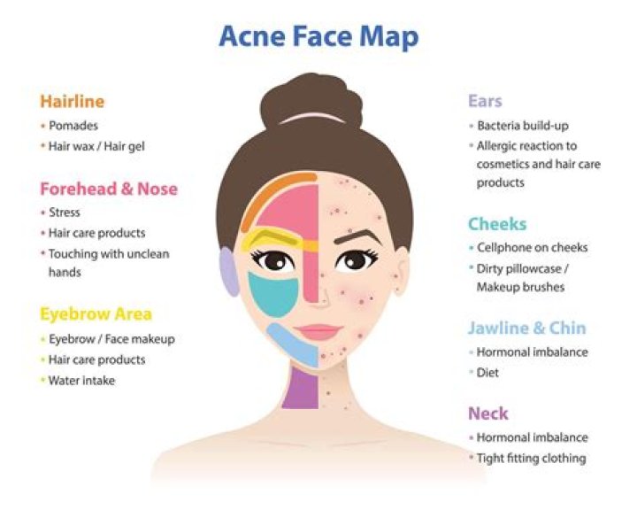 What can cause acne in adults?