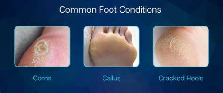 What causes a callus?