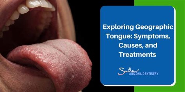 What causes a geographic tongue?
