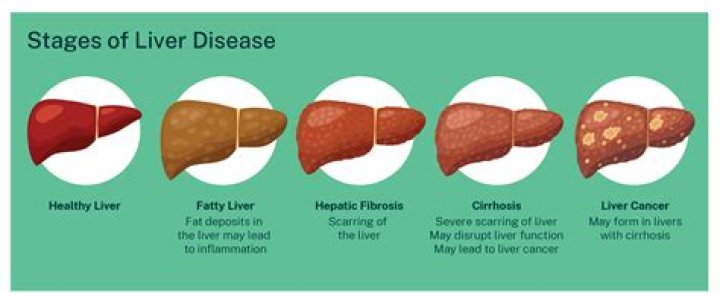 What causes calcification on the liver?
