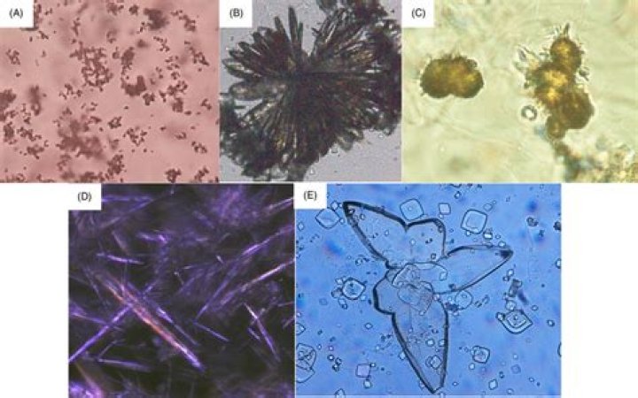 What causes calcium carbonate crystals in urine?