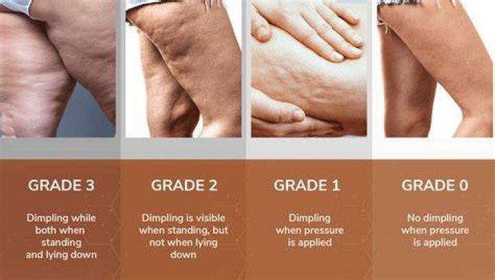 What causes cellulite in the legs?