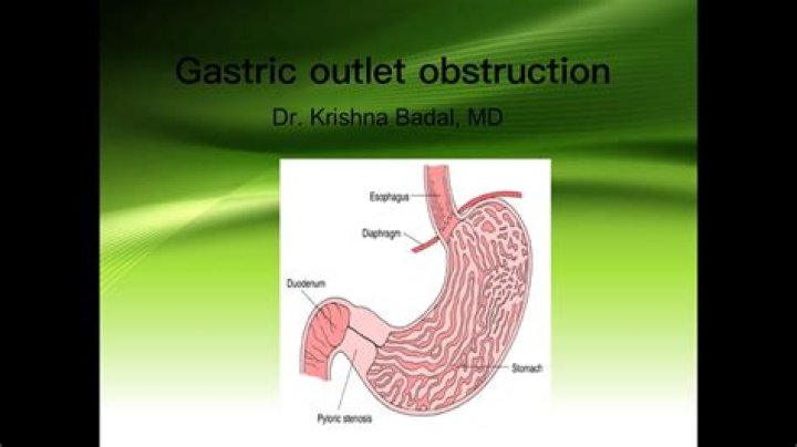 What causes gastric outlet obstruction?