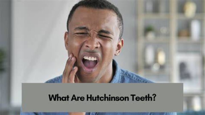 What causes Hutchinson's teeth? | ContextResponse.com