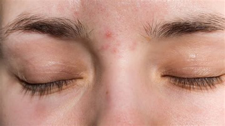 What causes itchy eyebrows?