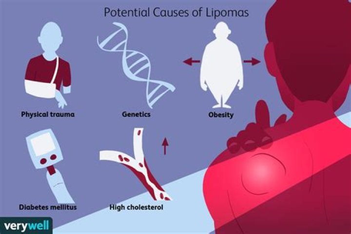 What causes lipoma lumps?