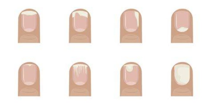 What causes nail bed separation?