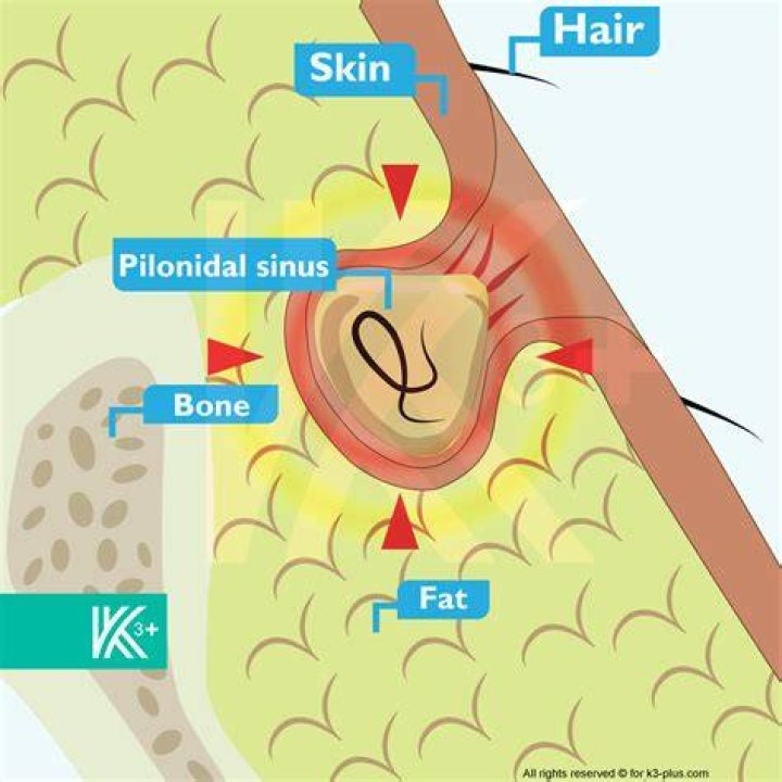 What causes pilonidal? | ContextResponse.com