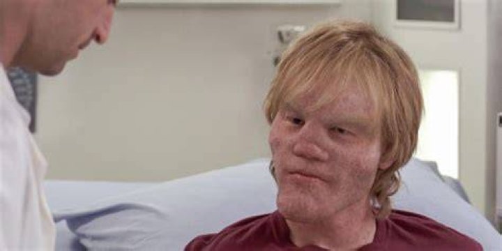 What disease did Jake Burton have?
