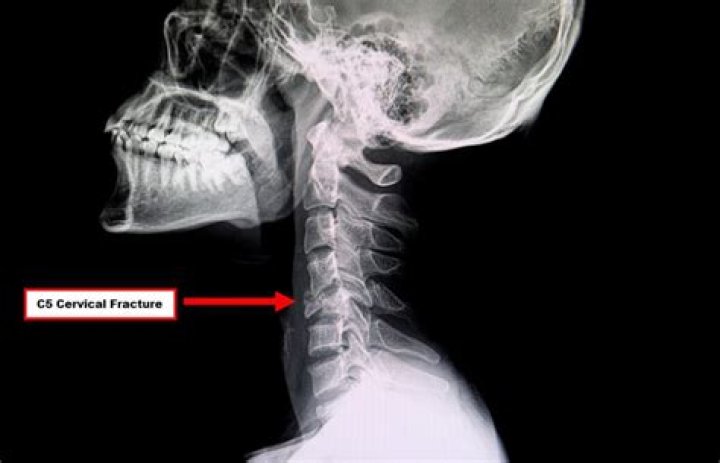 What do you do when someone breaks their neck?