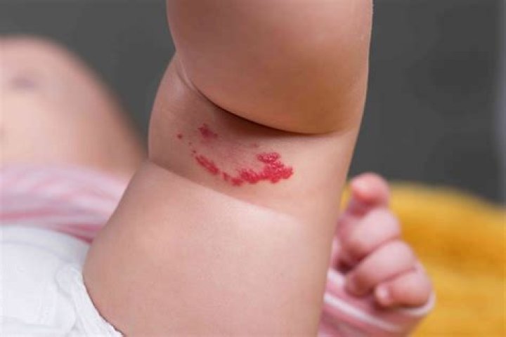 What does a birthmark on your left thigh mean?