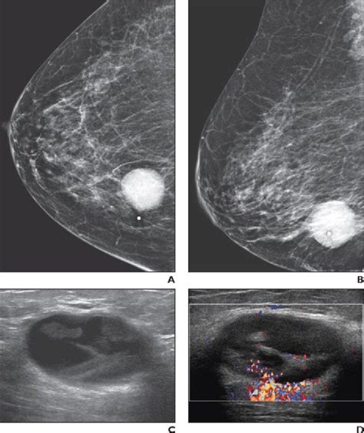What does a cyst look like on a mammogram?