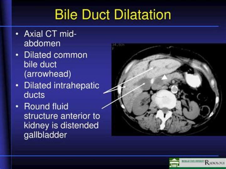 What does a dilated common bile duct mean?