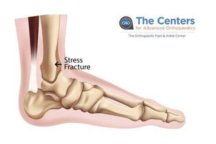 What does a heel stress fracture feel like?