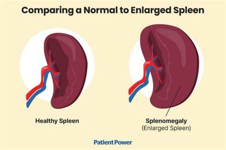 What does a swollen spleen feel like?