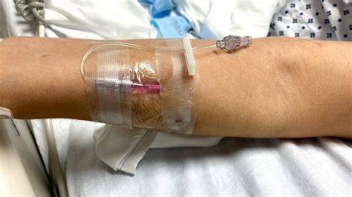 What does an infiltrated IV mean?