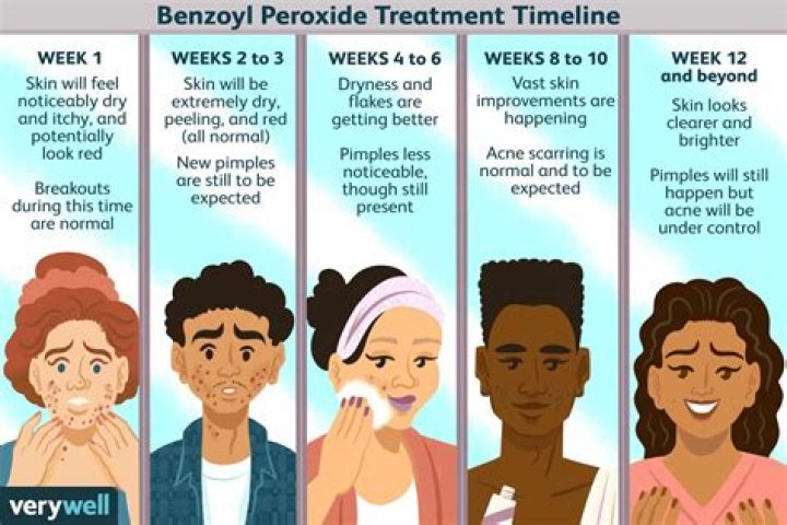 What does benzoyl peroxide do to your acne?