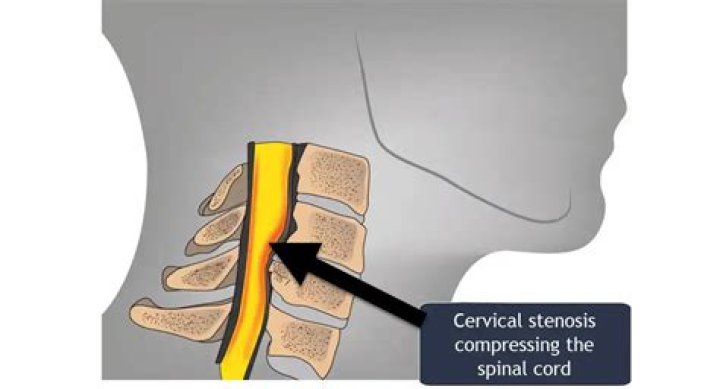 What does cervical stenosis look like?