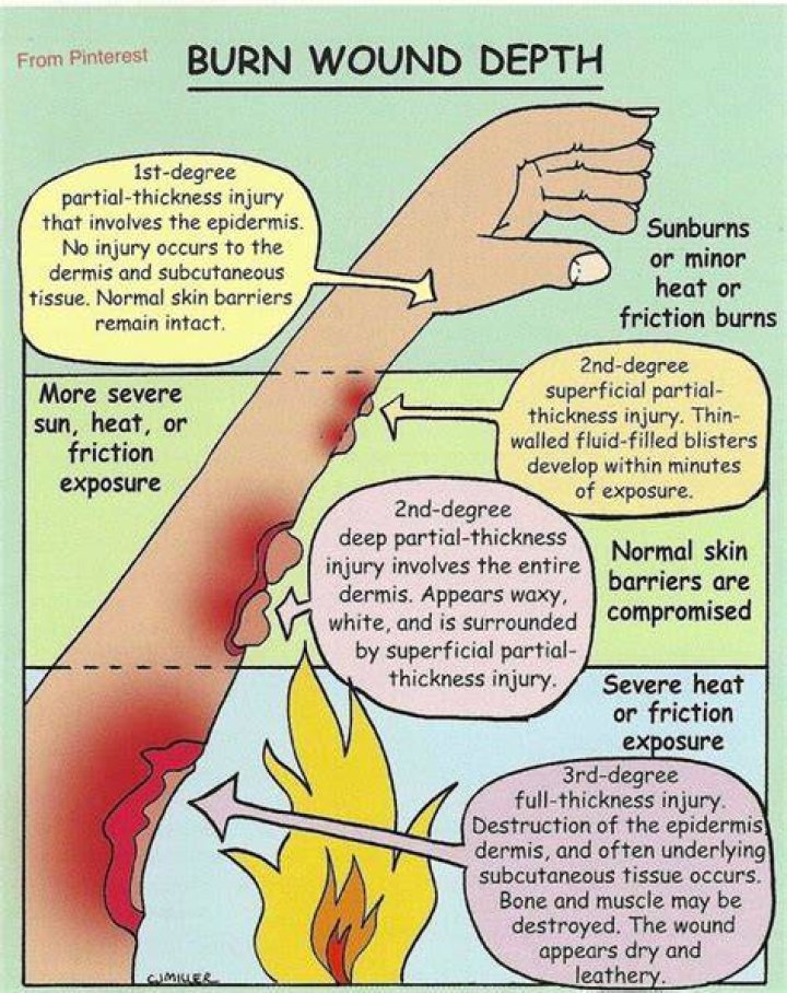 What does mustard do to Burns?