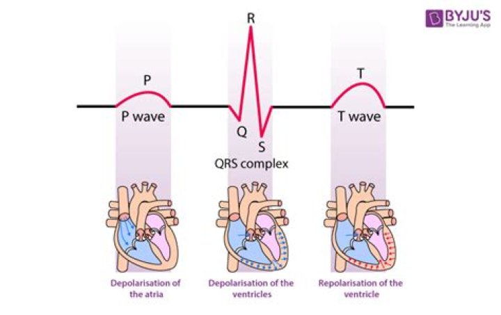 What does no P wave mean?