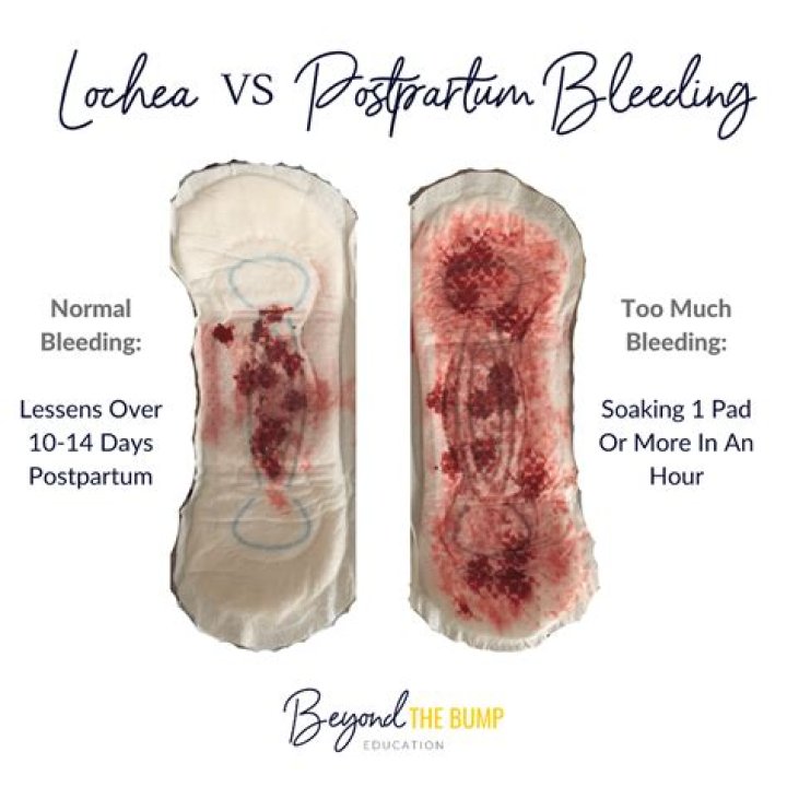 What does postpartum bleeding look like?