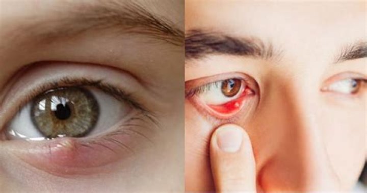 What happens if you pop a stye?