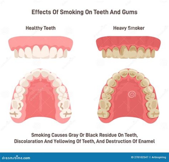 What happens to your teeth when you stop smoking?
