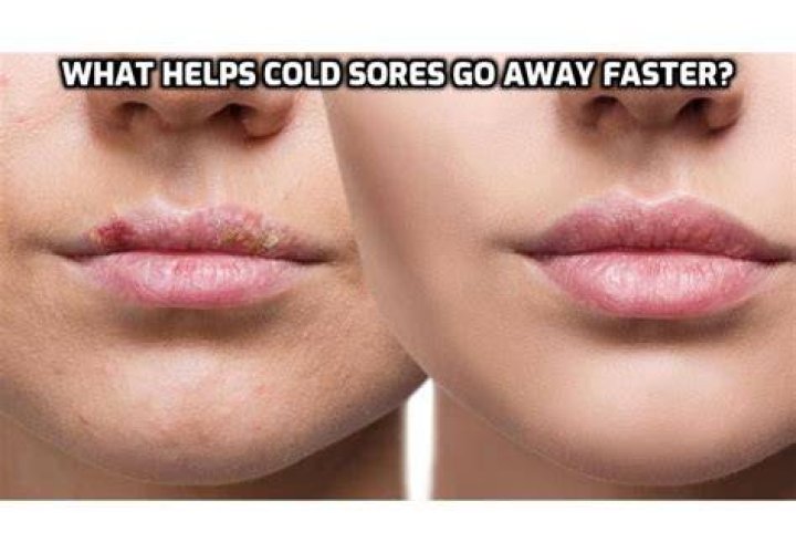 What helps cold sores go away faster?