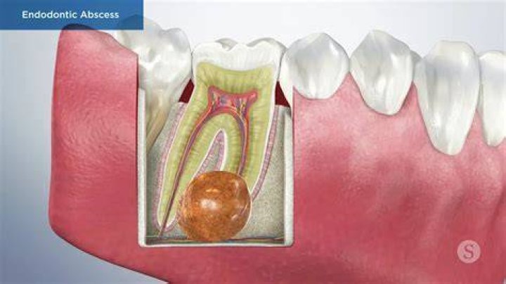 What is a chronic abscess on tooth?