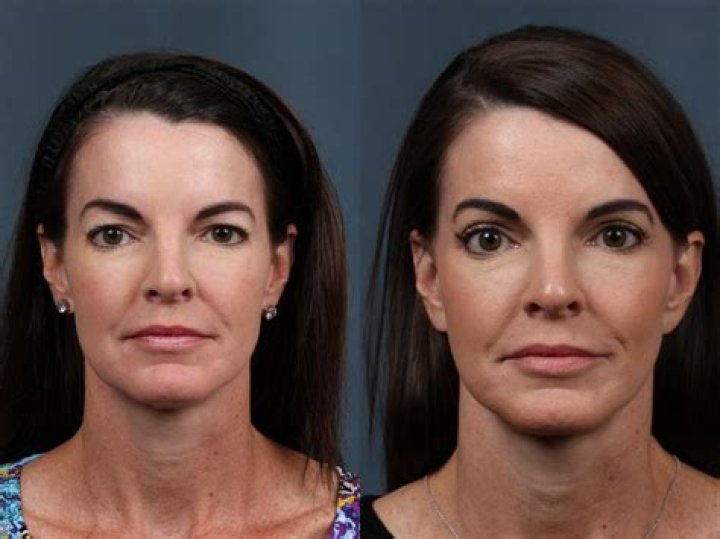 What is a composite facelift?