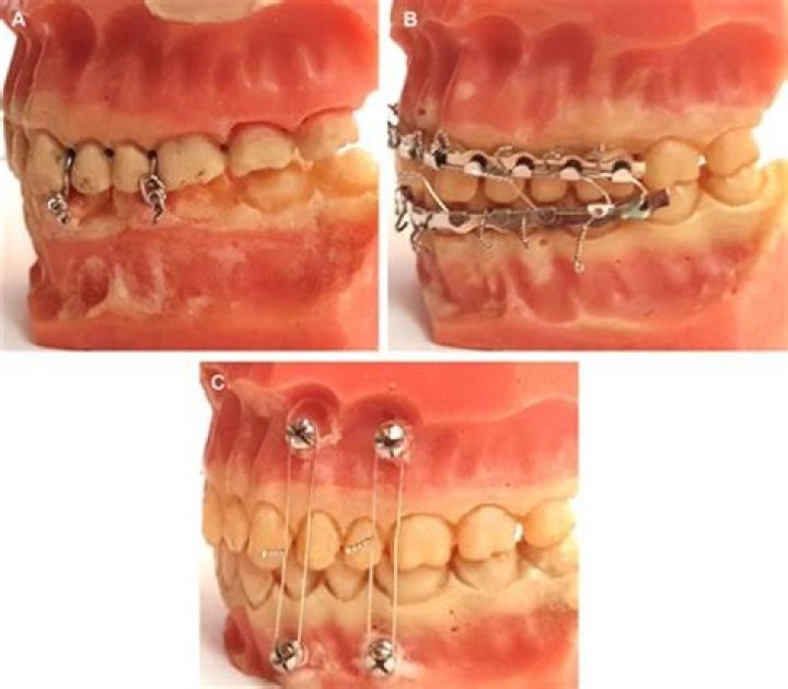 What is a fixation plate?