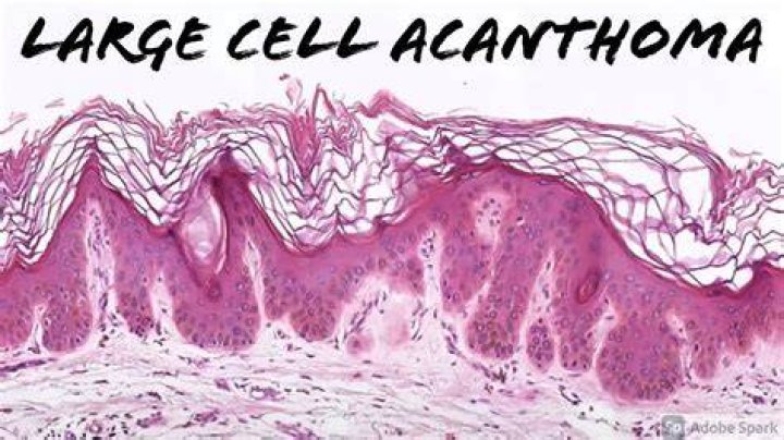 What is a large cell Acanthoma?
