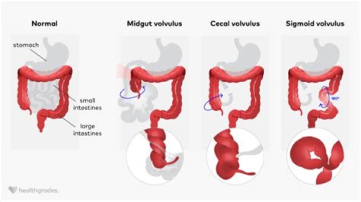 What is a sigmoid volvulus?