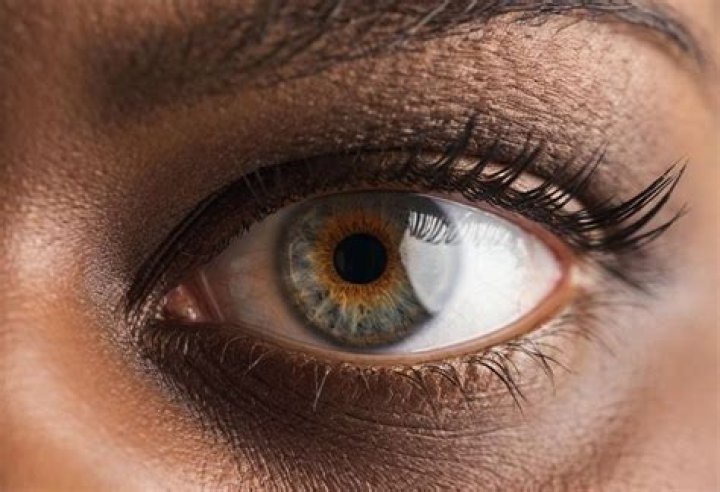 What is a starburst in the eye?
