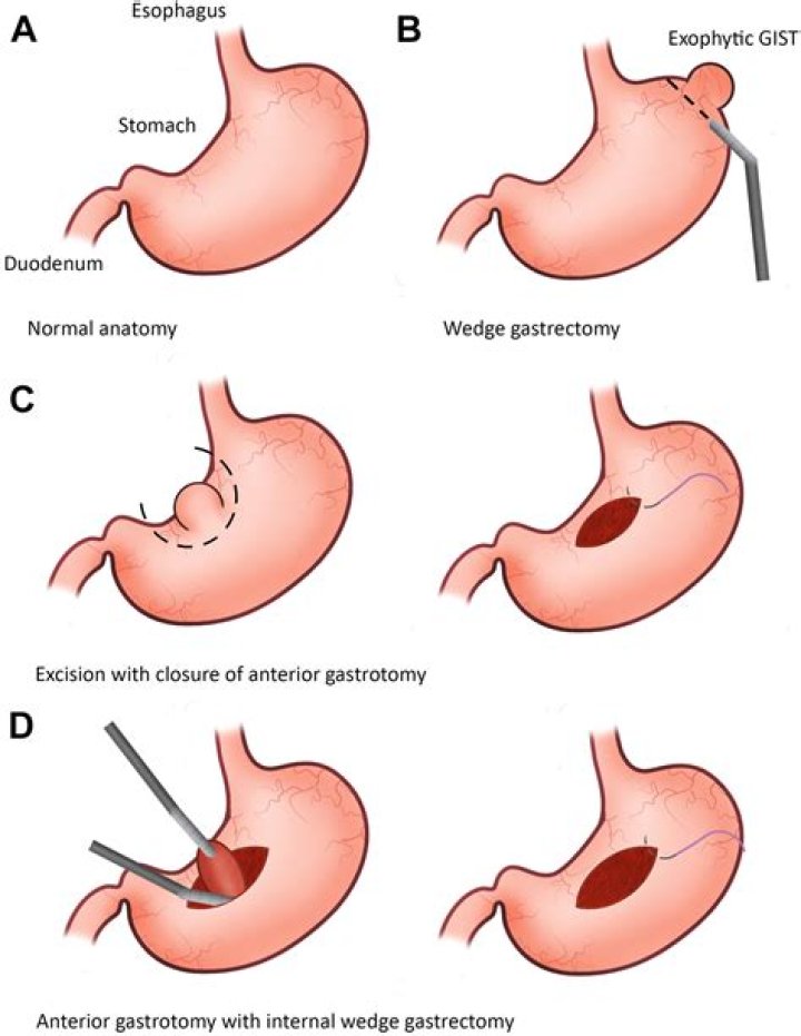 What is a stomach resection?