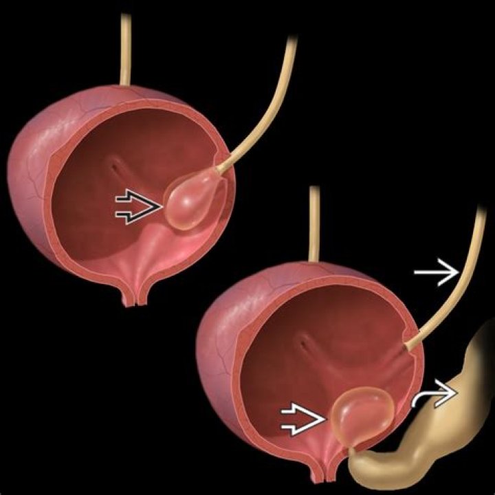 What is a Ureterocele? | ContextResponse.com