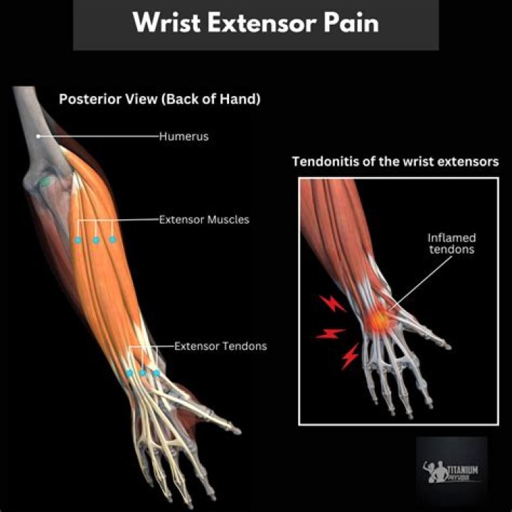 What is an example of an extensor muscle?