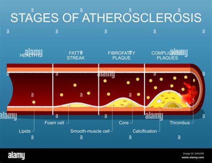 What is atherosclerosis calcification?