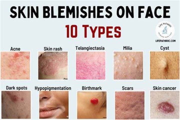 What is blemish on skin?